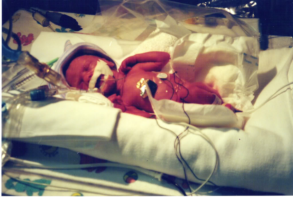 Premature baby in NICU due to pregnancy complication HELLP 