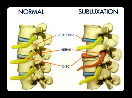 Comparison of Normal spine and damaged subluxation 